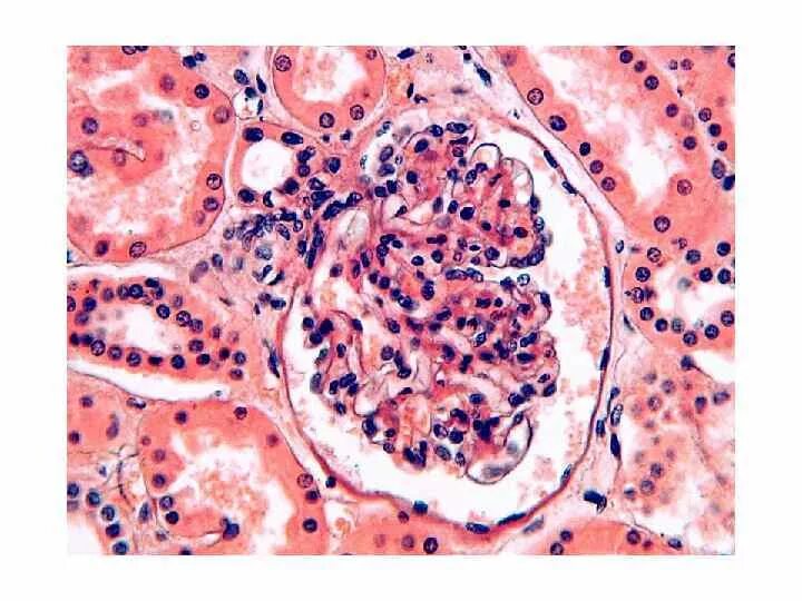 Нефрон гистология препарат. Почечные канальцы гистология. Гиалиново капельная дистрофия гистология. Эпителий почечных канальцев гистология.