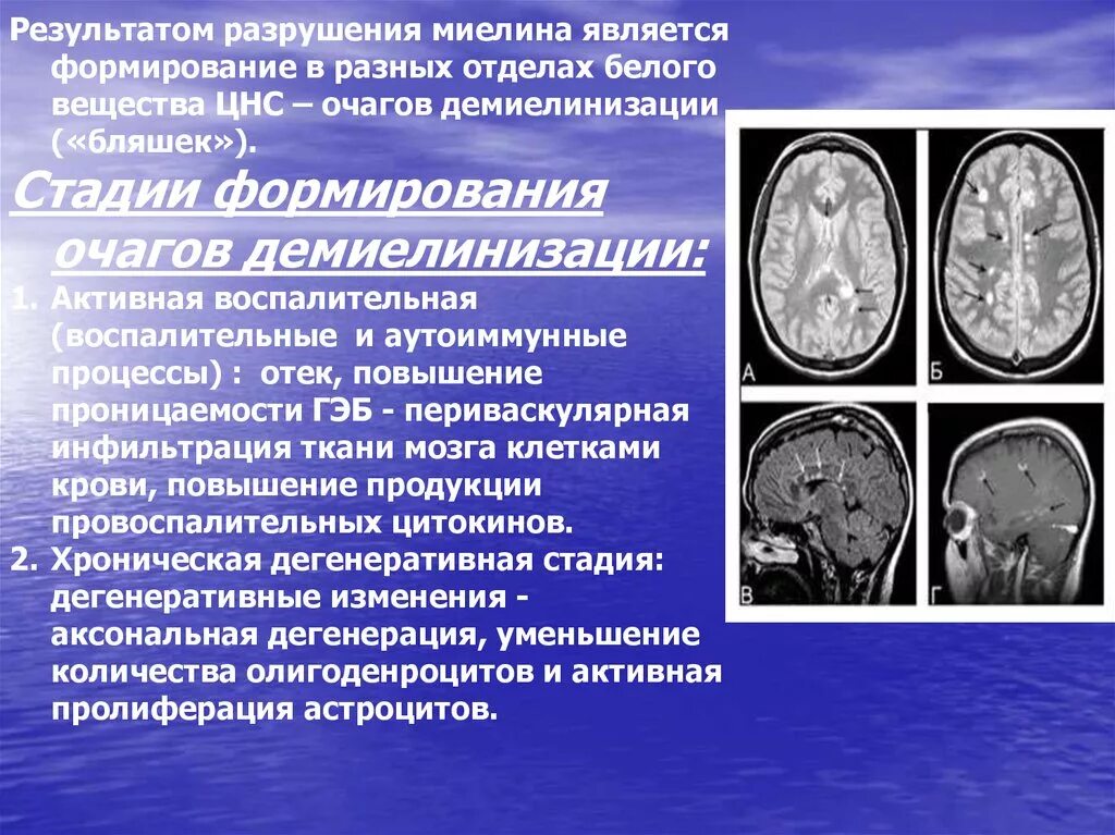 Что означает очаговое изменение мозга. Рассеянный склероз демиелинизация. Очаги демиелинизации головного мозга на мрт. Демиелинизирующие заболевания головного мозга кт. Демиелинизирующий процесс головного мозга что это такое.