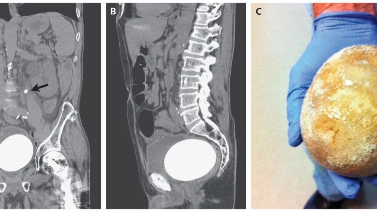 Мочекаменная болезнь камни в мочевом пузыре. Камни в мочеточнике и мочевом пузыре. Конкремент мочевого пузыря кт. Самый огромный камень в почках. Камни в мочевом у мужчин лечение