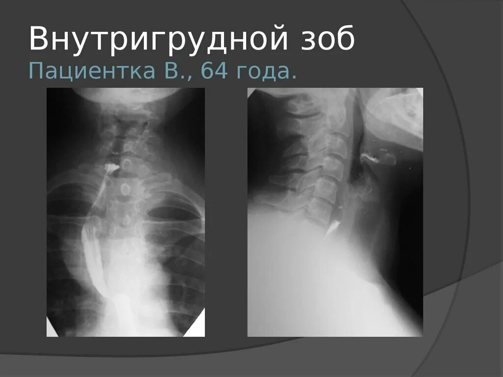 Загрудинный зоб рентген. Загрудинный зоб на рентгенограмме. Внутригрудной и загрудинный зоб. Пищевод зоб