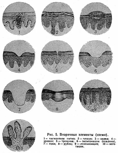 Вторичные элементы поражения. Экскориация вторичный морфологический элемент. Первичные морфологические элементы сыпи. Вторичные морфологические элементы Дерматовенерология. Первичные морфологические элементы поражения кожи.