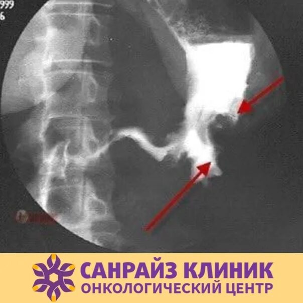 Опухоль желудка рентген. Раковая опухоль желудка рентген. Рентген язвы желудка симптом ниши. Язва кт