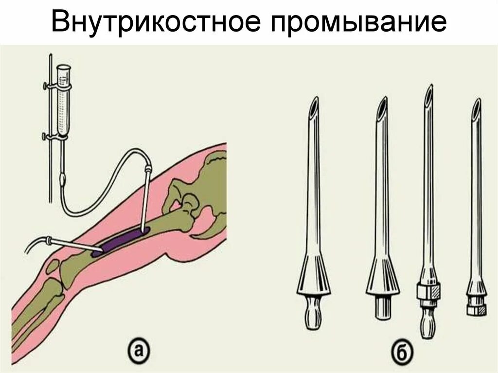 Промывание гнойной раны. Острый гематогенный остеомиелит остеоперфорация. Пункция кости при остеомиелите. Остеоперфорация кости. Гематогенный остеомиелит операция.