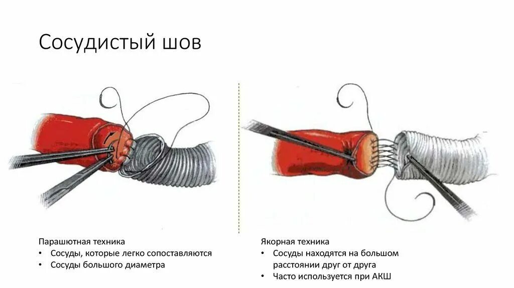 Наложение шва латынь. Сосудистый шов Парашютная техника. Парашютная техника наложения сосудистого шва. Принципы наложения сосудистого шва. Наложение шва на кровеносный сосуд.