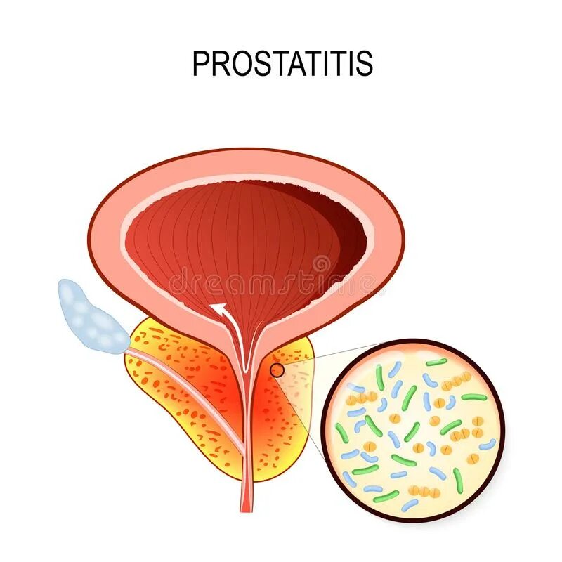 Простата крупный план. Простатит вектор. Энтерококк простатит. Простатит крупный план.