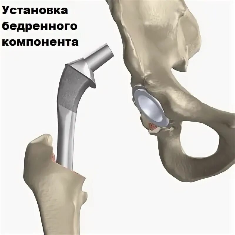 Спейсер протез тазобедренного сустава. Эндопротезирование при переломе шейки бедра. Артикулирующий спейсер тазобедренного сустава. ТБ спейсер тазобедренный сустав.