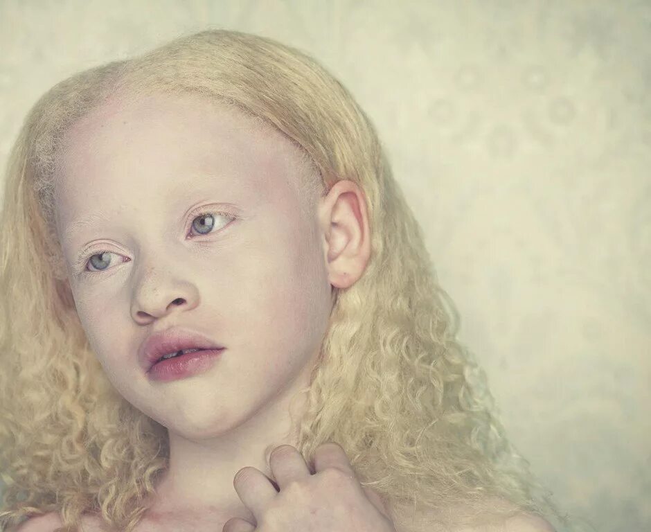 Глазокожный альбинизм 2. Монголоиды альбиносы. Афроамериканец альбинос. Температурно чувствительный альбинизм.