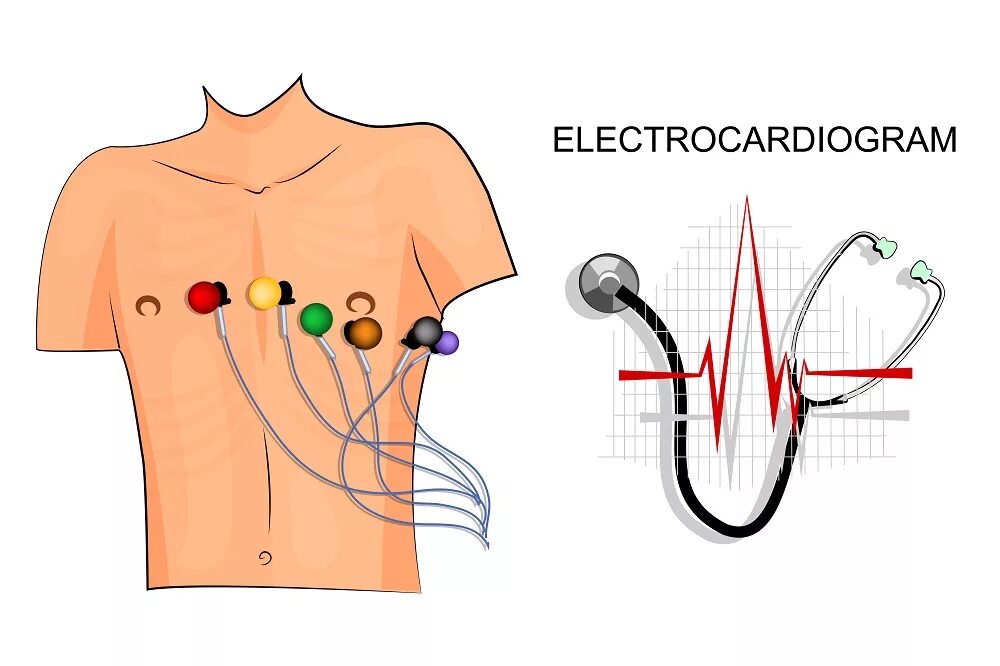 ЭКГ сердца схема наложения электродов. Электроды ЭКГ схема наложения электродов. Техника наложения грудных электродов ЭКГ. ЭКГ сердца наложение электродов. Соп экг