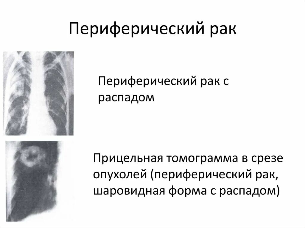 Периферическая опухоль с централизацией. Симптом вырезки Риглера. Признаки периферического легкого