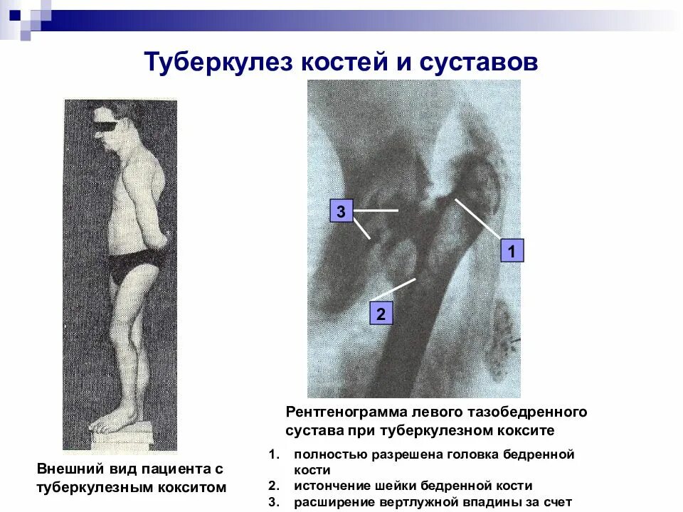 Коленный туберкулез