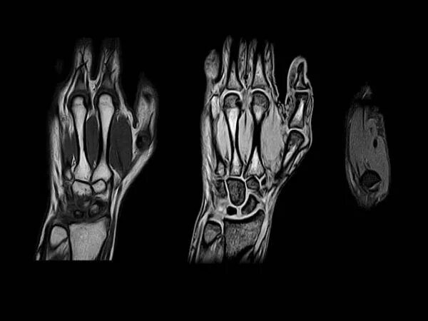 Делают ли мрт руки. Мрт лучезапястного сустава. Артрит лучезапястного сустава мрт. Ревматоидный артрит мрт лучезапястный. Снимок мрт лучезапястного сустава.