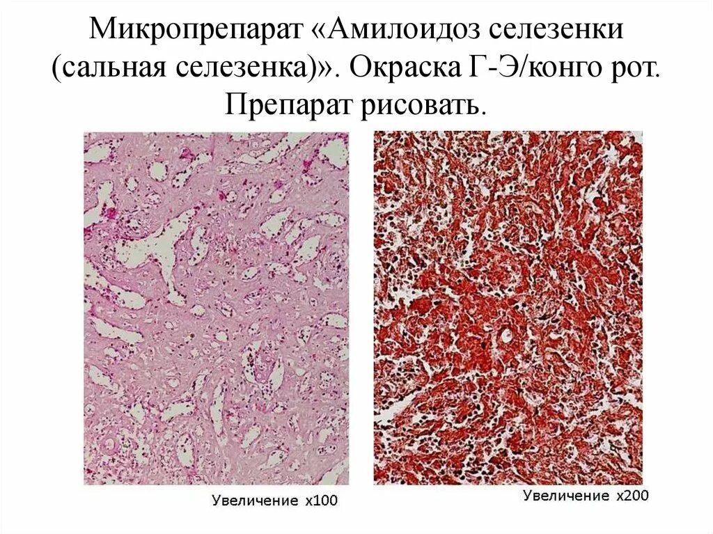 Саговая селезенка. Амилоидоз селезенки макропрепарат. Амилоидоз почки (окраска Конго-красным и гематоксилином). Сальная селезенка патанатомия. Амилоидоз печени патанатомия.