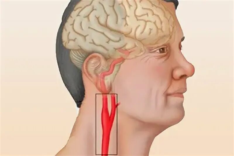 Аневризма сонной артерии что это. Аневризма сонной артерии шеи. Аневризма сонной артерии головного мозга. Мешковидная аневризма сонной артерии. Аневризма сонной артерии шеи операция.