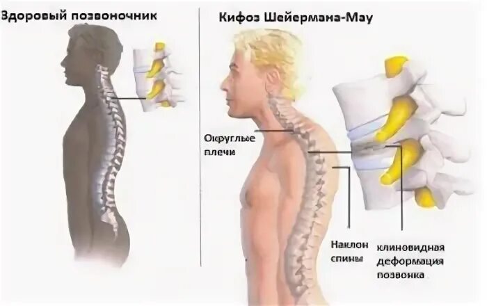 Искривление позвоночника Шейермана МАУ. Юношеский кифоз болезнь Шейермана-МАУ. Операция на спину Шейермана МАУ.