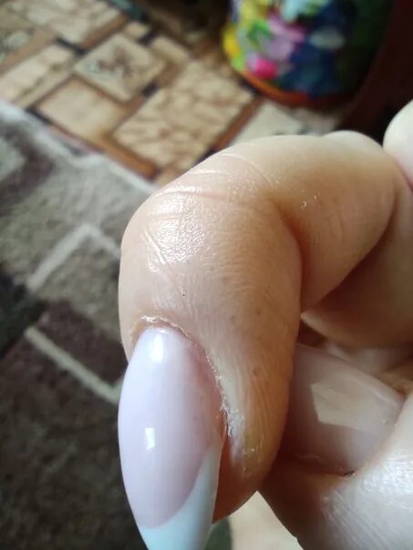 Аллергия на гель лак волдыри на пальцах.