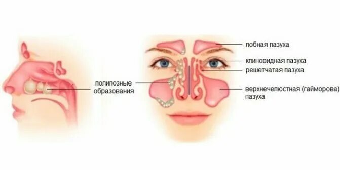 Почему горит нос. Полипозный синусит гайморовой пазухи. Хронический полипозно-Гнойный риносинусит.. Синусит верхнечелюстной пазухи.