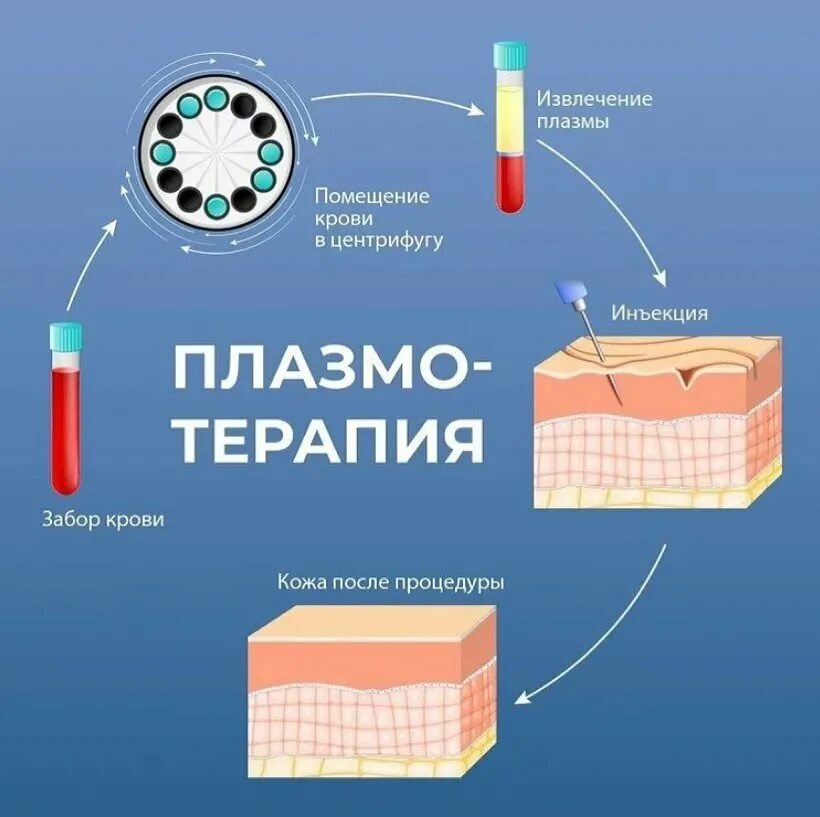 Плазмолифтинг сколько нужно процедур. PRP-терапия плазмотерапия. Плазмотерапия суставов (PRP-терапия, плазмолифтинг). Техника проведения плазмолифтинга.