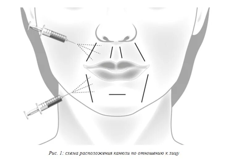 Как колоть филлер. Армирование лица гиалуроновой кислотой схема. Схема заполнения носогубной складки. Методика введениния филеров.