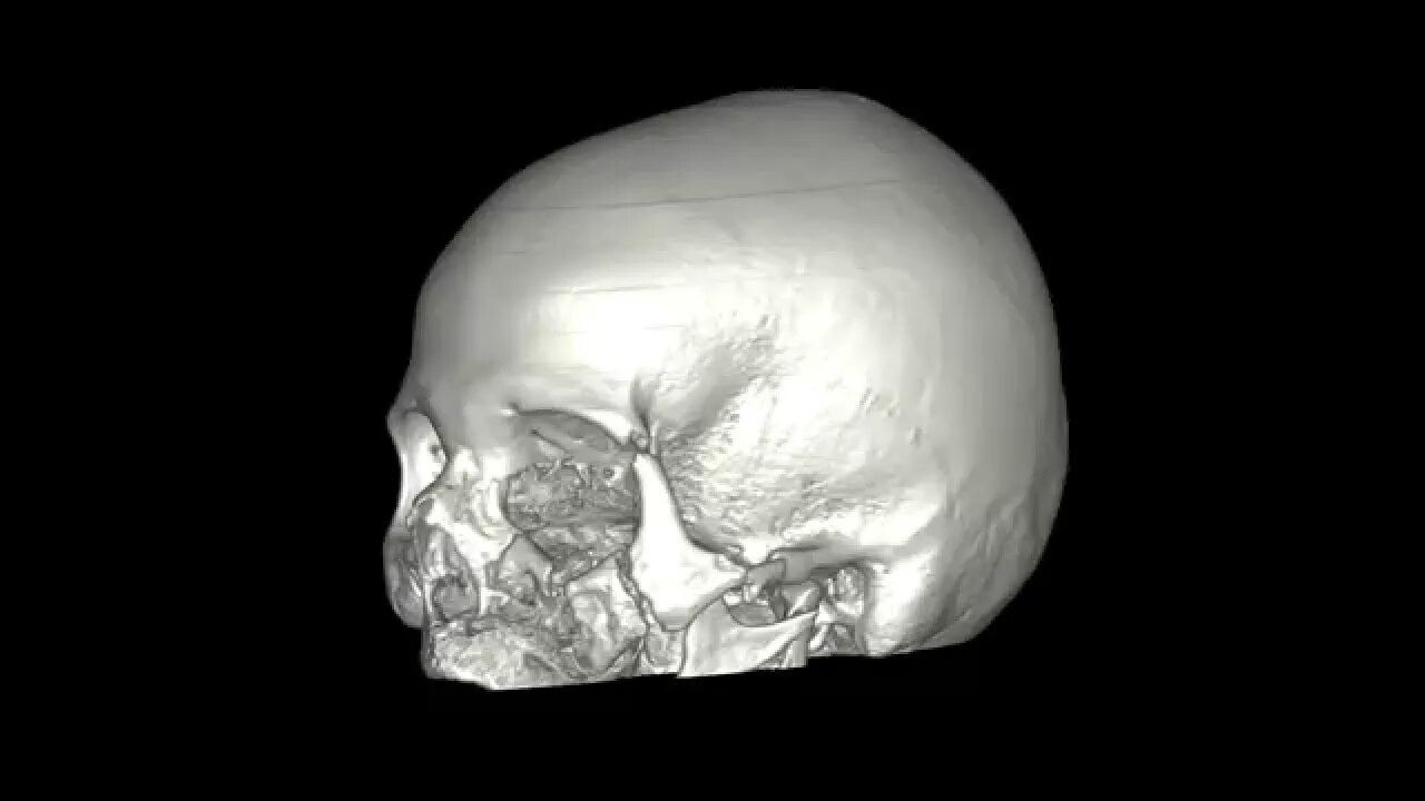 Оскольчатый перелом костей черепа. Переломы костей черепа на кт. Снимок перелом черепа (3d кт).