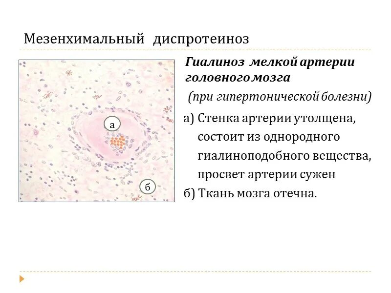 Белковые мезенхимальные дистрофии. Гиалиноз сосудов селезенки. Гиалиноз сосудов при гипертонической болезни. Гиалиноз сосудов мозга.