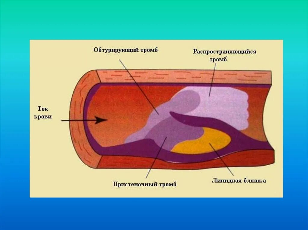 Организация тромба