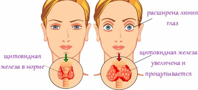 Как должна выглядеть щитовидка Childhood Thyroid Cancer NCI