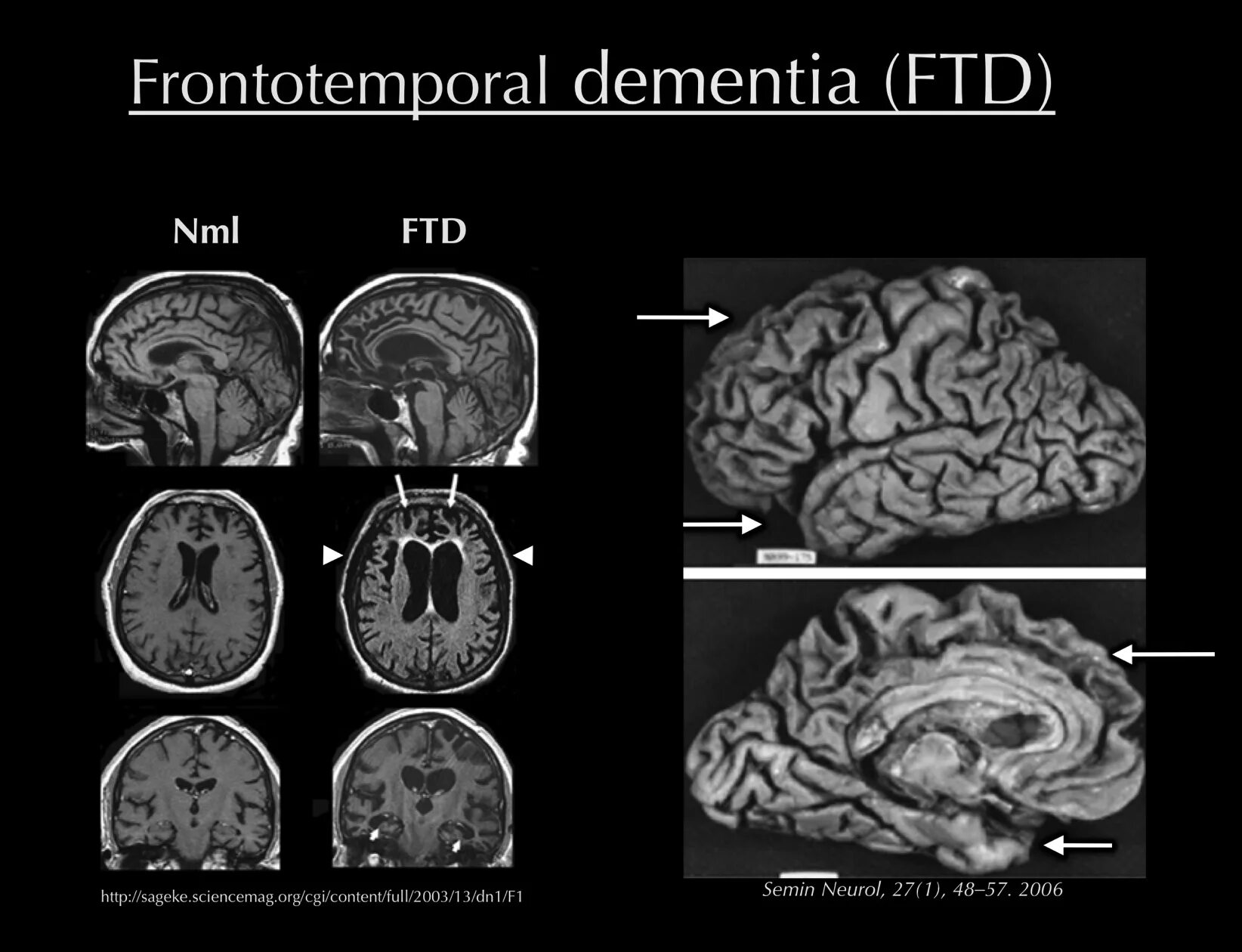 Brain disorders. Frontotemporal Dementia. Фронтотемпоральная деменция мрт. Мозг при деменции как выглядит.