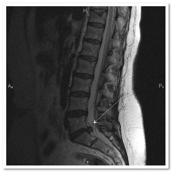 Грыжи поясничного отдела позвоночника у женщин. Межпозвоночная грыжа пояснично-крестцового. Грыжа пояснично-крестцового отдела позвоночника симптомы l4 l6. Грыжа позвоночника поясничного крестцового. Снимок пояснично-крестцового отдела позвоночника с грыжей.