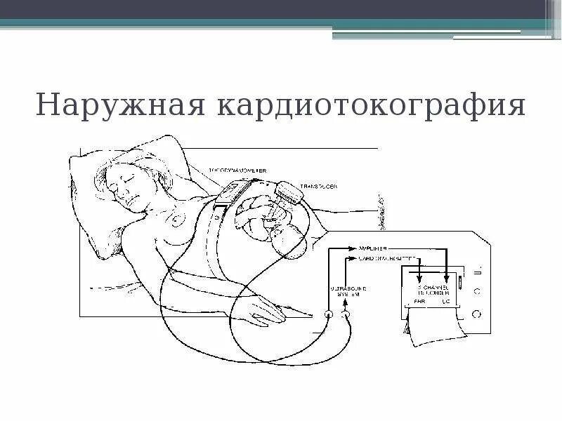 Алгоритм ктг. Тензометрический датчик ктг. ктг постановка датчиков. ктг алгоритм манипуляции.