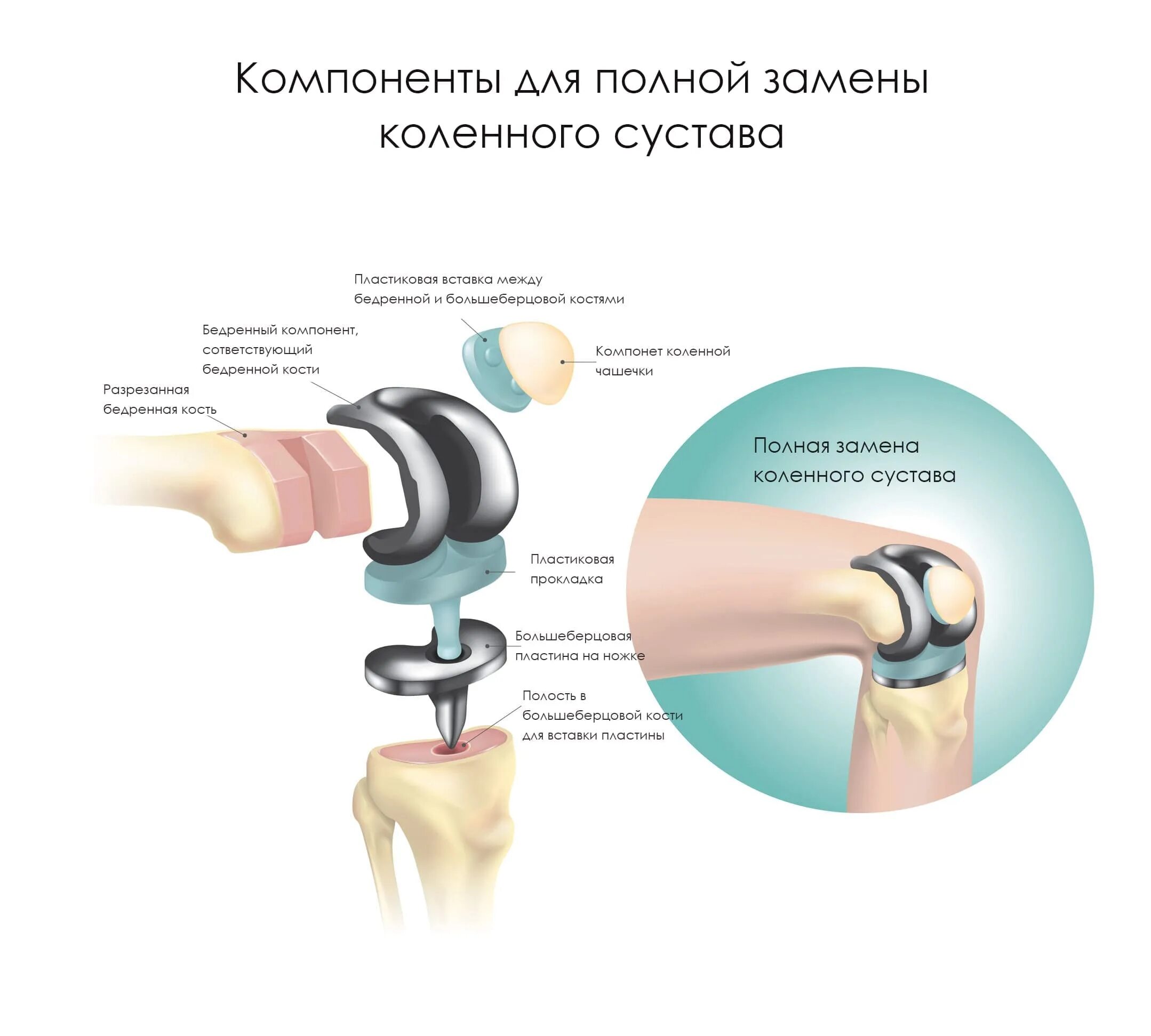 Полный эндопротез коленного сустава. Zimmer протезы коленного сустава. Компоненты эндопротеза коленного сустава. Протез Зиммер коленный сустав. Операция по замене коленного сустава москва