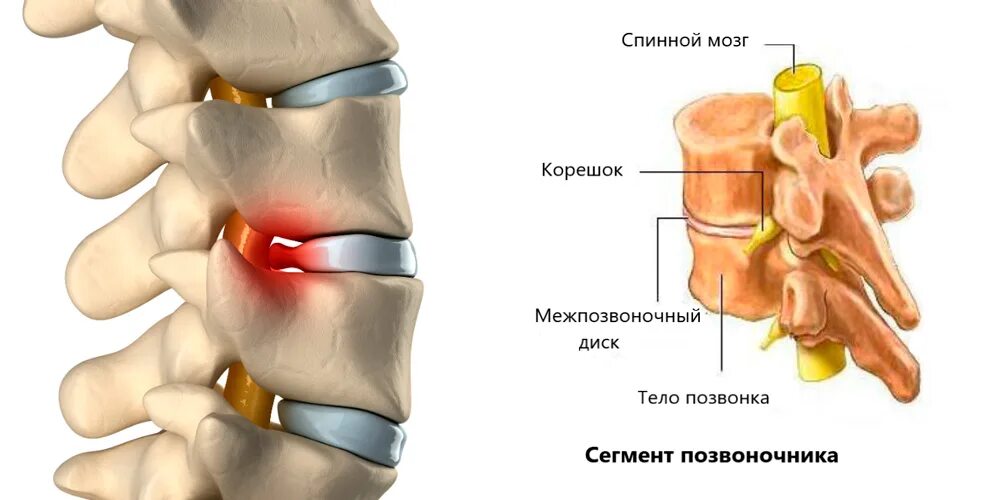 Грыжа межпозвонковых дисков l5-s1. Дорзальная секвестрированная грыжа l5/s1. Грыжа диска позвоночника l5 s1. Дорзальная протрузия l4-l5 симптомы. Диффузное выбухание межпозвоночного