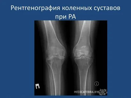 Ревматоидный артрит коленного сустава