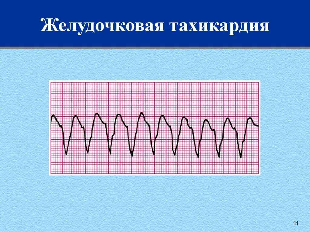 Желудочковая тахикардия на экг. Тахикардия желудочков на ЭКГ. Веретенообразная желудочковая тахикардия ЭКГ. Пароксизмальная тахикардия желудочков ЭКГ.