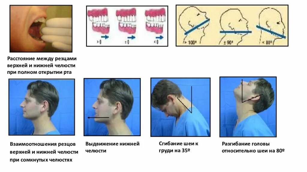 Почему не открывается рот. Выдвижение нижней челюсти. Выдвигание нижней челюсти. Положение нижней чедюст. Нормальное положение нижней челюсти относительно верхней.