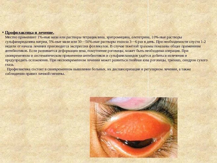 Лечение инфекции глаза у взрослых