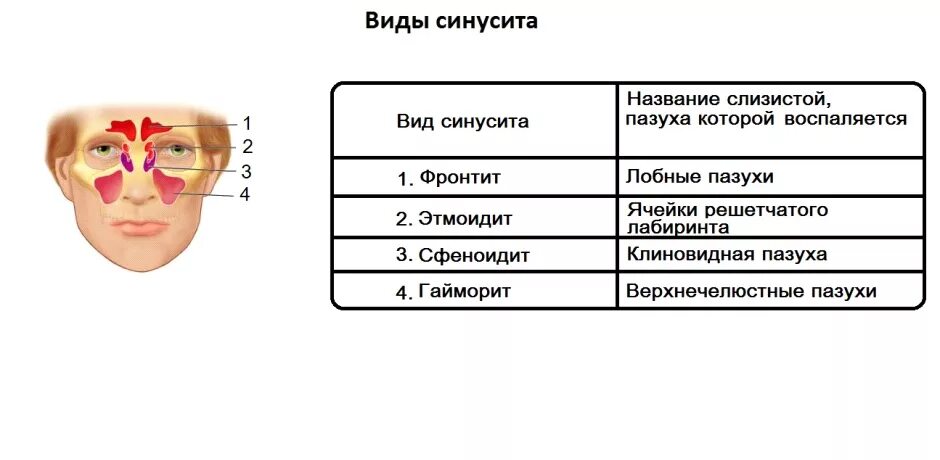 Таблица гайморит фронтит симптомы. Таблица гайморит фронтит. Чем отличается полусинусит от синусита. Гайморит синусит фронтит отличия. Заболевания головные заболеваниях носа