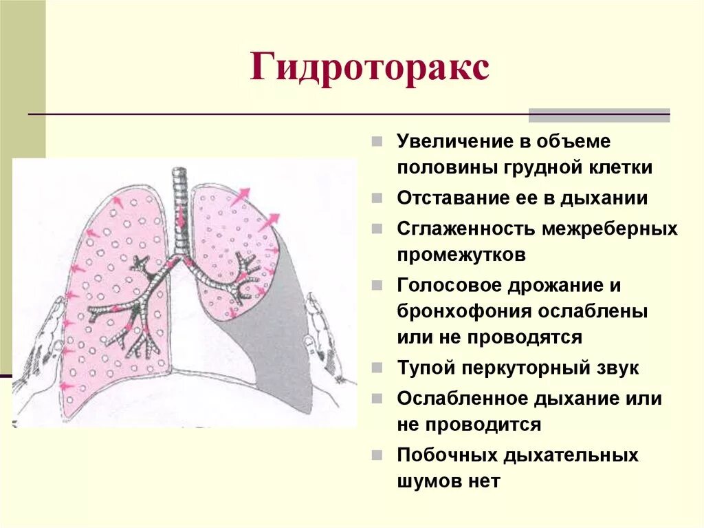 Клинические признаки гидроторакса. Гидроторакс легких ПВБ. Гидроторакс УЗИ плевральных полостей. Гидроторакс клинические проявления.