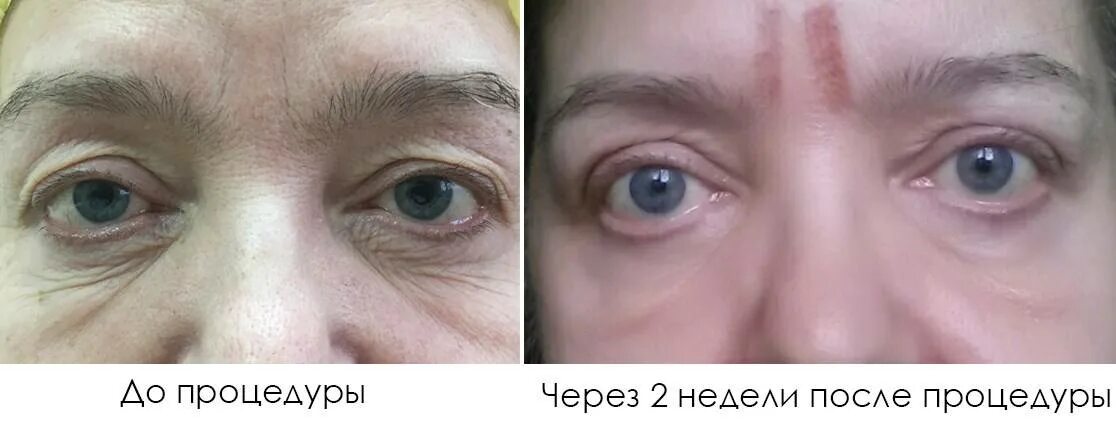 Холодная плазма глаз. Блефаропластика Plasma Liner. Плазма лайнер блефаропластика. Безоперационная блефаропластика холодной плазмой. Безинъекционная блефаропластика век.