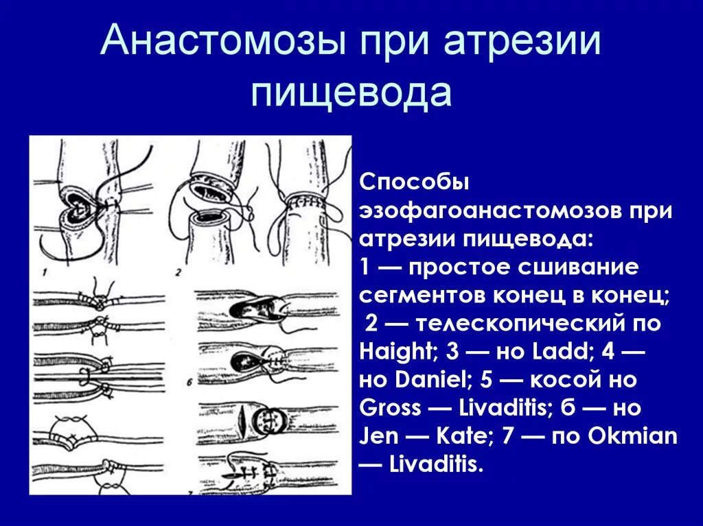 Атрезия пищевода эзофагоскопия. Безсвищевая форма атрезии пищевода. Атрезия пищевода контрастное исследование. Слепой пищевод