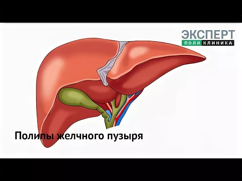 Полип в желчном симптомы лечение. Полиповидные образования желчного пузыря. воспалительные полипы желчного.