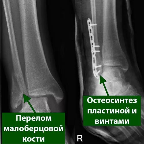 Чрезсиндесмозный перелом лодыжки. Закрытый перелом наружной лодыжки малоберцовой кости. Остеосинтез малоберцовой кости и лодыжки. Перелом лодыжек остеосинтез рентген. Операция малоберцовой кости