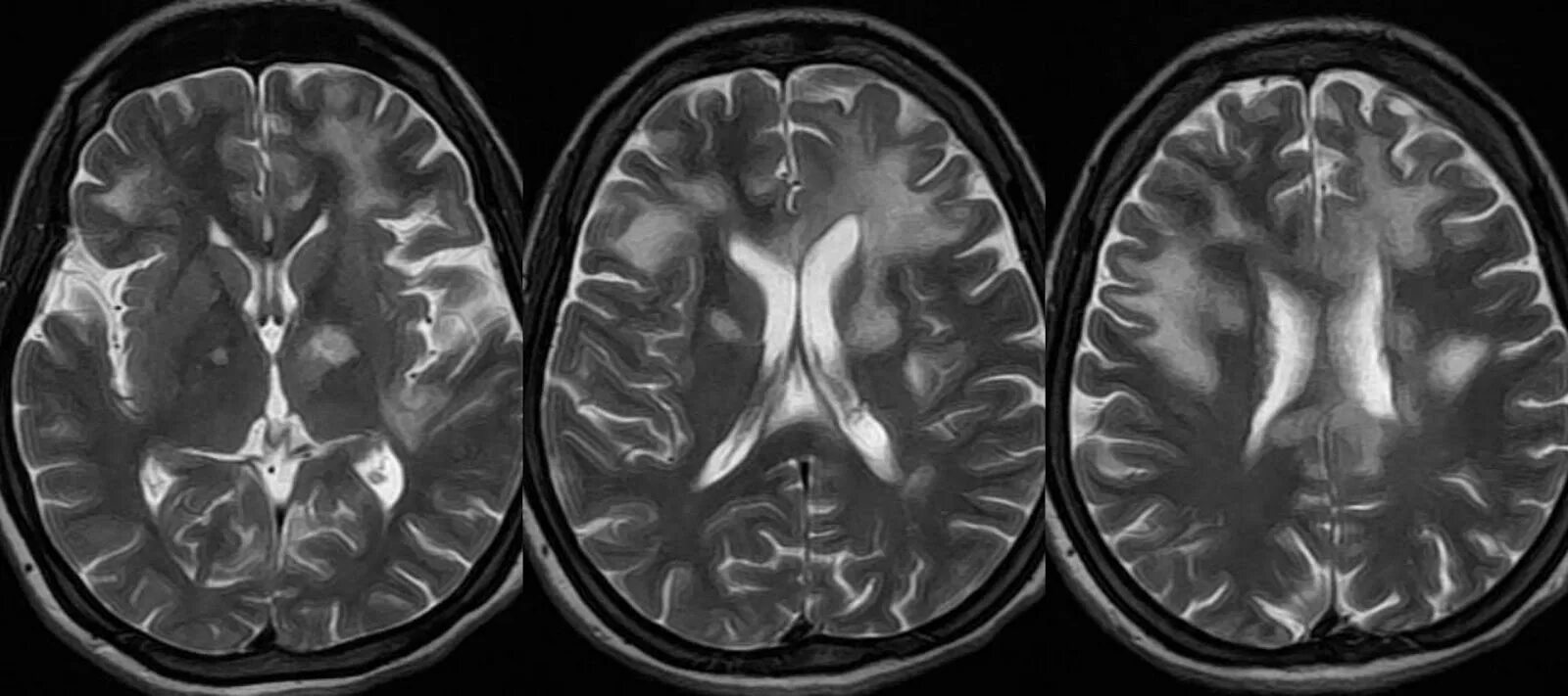 Прогрессирующая мультифокальная лейкоэнцефалопатия (ПМЛ). Прогрессирующая мультифокальная лейкоэнцефалопатия мрт. ПМЛ мрт прогрессирующая мультифокальная лейкоэнцефалопатия. Лейкоэнцефалопатия головного мозга мрт. Многоочаговое поражение головного мозга