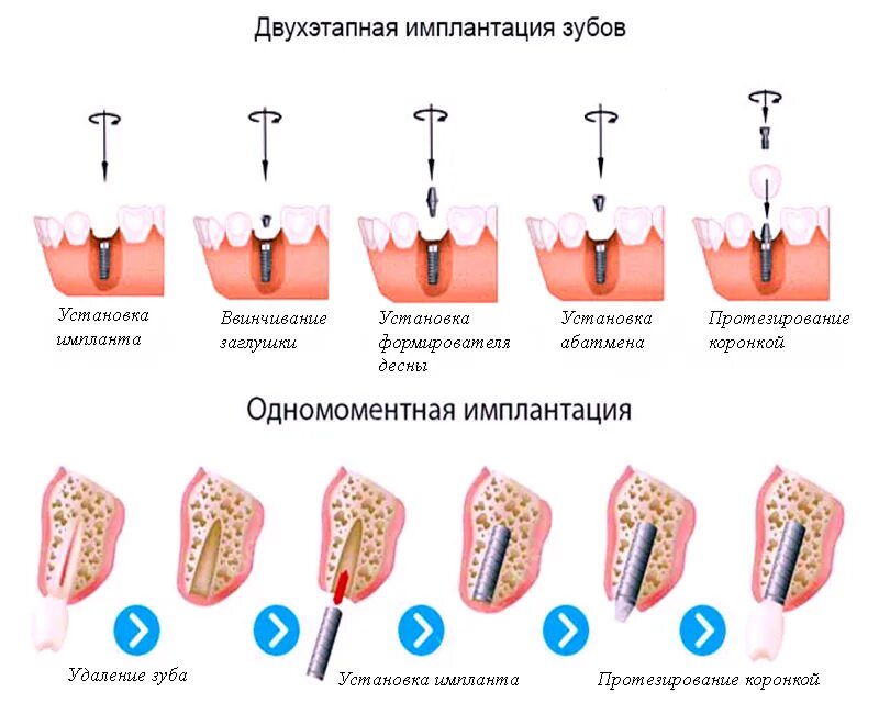 Можно ли поставить зуб после удаления. Этапы приживления импланта зуба. двухэтапная имплантация зубов этапы.