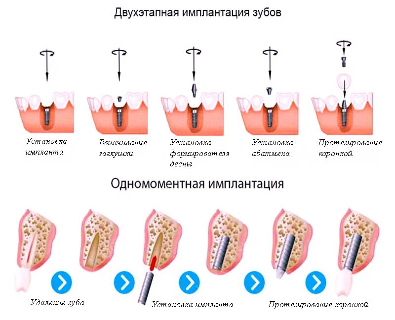 Как называется протезист. Этапы имплантации зуба абатмент. Схема установки импланта зуба. Как устанавливается имплант зуба этапы. Этапы имплантации и протезирования.