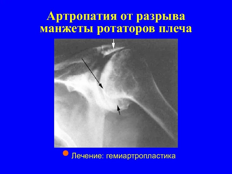 Синдром сдавления ротатора плеча. Разрыв ротаторной манжеты плечевого сустава рентген. травма ротаторной манжеты плеча. повреждение вращательной манжеты плечевого сустава на рентгене. разрыв ротаторной манжеты плечевого сустава мрт.