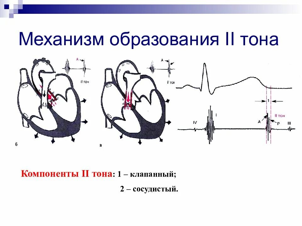 2 тон сердца. Механизм образования 2 тона сердца. механизм образования первого тона сердца. механизм образования 3 и 4 тонов сердца. механизм образования тонов сердца пропедевтика.