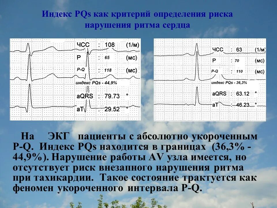 Увеличение интервала pq. Синдром укороченного PQ на ЭКГ. Синдром укорочения интервала PQ на ЭКГ. Синдром короткого PQ на ЭКГ. Укороченный интервал PQ синдром CLC.