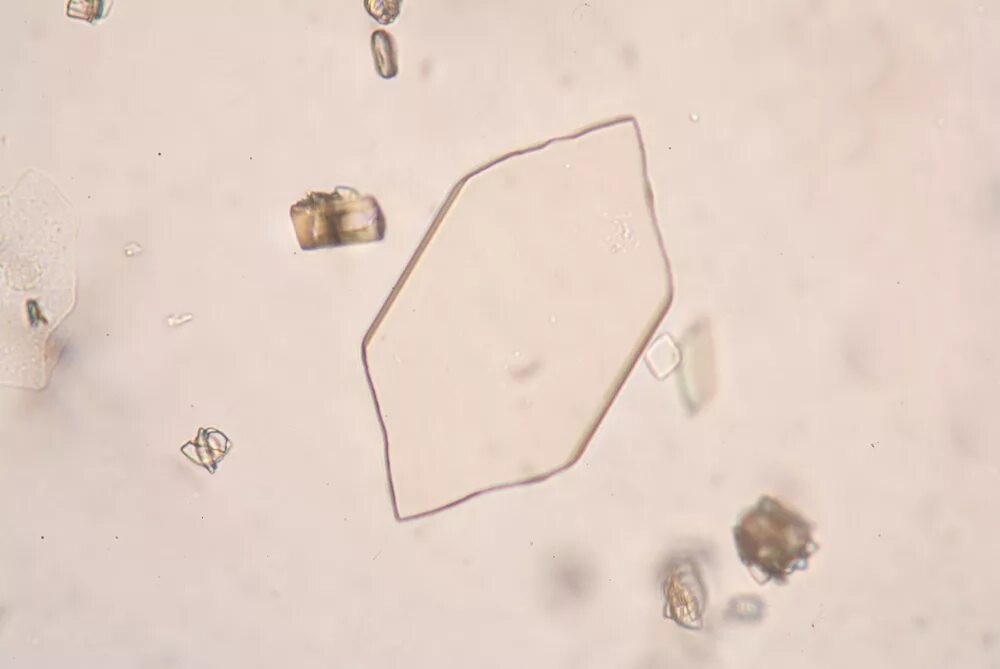Повышен цистин в моче. Кристаллы мочевой кислоты микроскопия. Микроскопия мочи Кристаллы мочевой кислоты. Кристаллы мочевой кислоты в моче микроскопия. Ураты микроскопия.