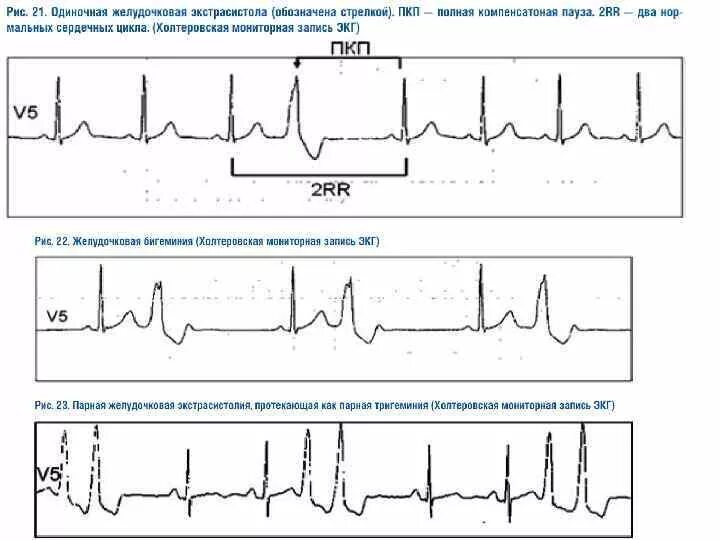 Желудочковая бигеминия на ЭКГ. ЭКГ при бигеминии. Тригеминия желудочковая экстрасистолия. Желудочковая экстрасистолия по типу бигеминии на ЭКГ. Типы желудочковых экстрасистол
