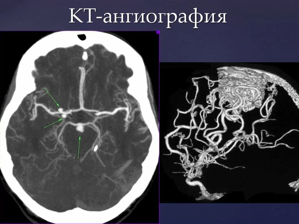 Венография головного мозга. Ангиография головного мозга. Ангиография сосудов головного мозга.